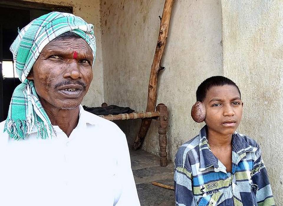 Adivasi boy denied school admission because of lump on ear