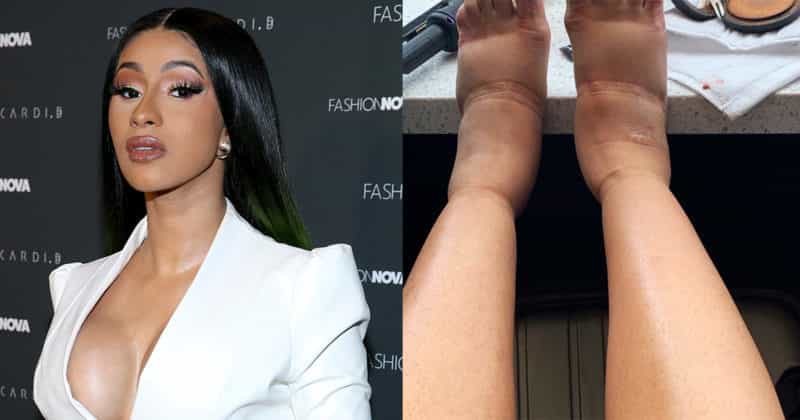 Fans Speculate That Cardi B’s Extremely Swollen Ankles and Are Due to Plastic Surgery