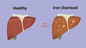Genetic study of the causes of excess liver iron may lead to better treatment