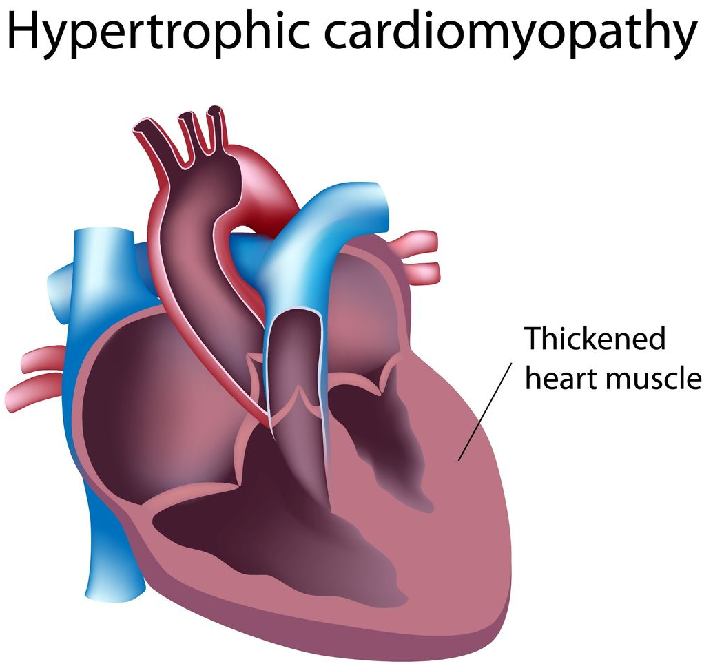Dr. Roach: High blood pressure can thicken heart wall