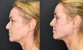 Cosmetic surgery without going under the knife: Before and After