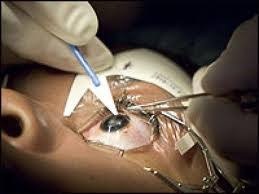 LASIK Surgery In King Of Prussia Performed By Award-Winning Doctors