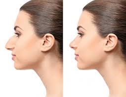 Know Everything About Rhinoplasty AKA Nose Job