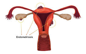 Know the Signs of Endometriosis