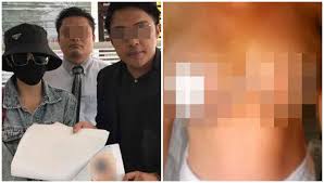 Woman Pays RM9,590 For Breast Reduction Surgery That Made Nipples Rot and Fall Off