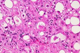 NIH: Drug reverses liver fat, slows fibrosis in HIV-positive people