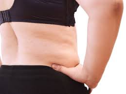 Overweight, obese patients rate tummy tuck results highly