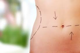 Study: Majority of overweight or obese patients happy with abdominoplasty