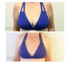 Have you heard of a Scarless Breast Lift?