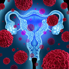 Study Identifies Factors of Microbiome Composition in Endometrial Cancer
