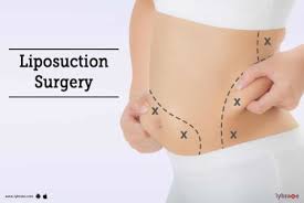 Liposuction Devices Market Projected to Garner Significant Revenues by 2027