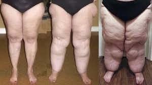 Treating lipedema with liposuction could benefit women with ‘painful fat’ disease