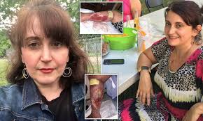 Mother, 42, is left with a gaping gangrenous HOLE in her leg after ‘botched’ liposuction to remove fat from her limbs