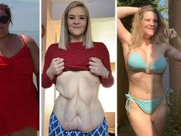 ‘I spent £18,000 on tummy tuck and it transformed my life’ – Steph took action after near 14st loss