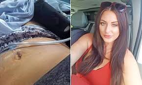 Tummy Tuck Surgery Fail Leaves Woman With Tennis Ball-Sized Hole In Stomach