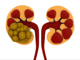 What Causes Kidney Stones?