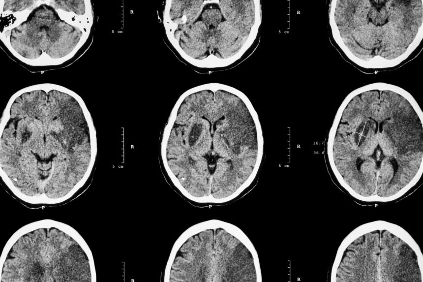 Migraine Headache and Risk for Cardiovascular and Cerebrovascular Events