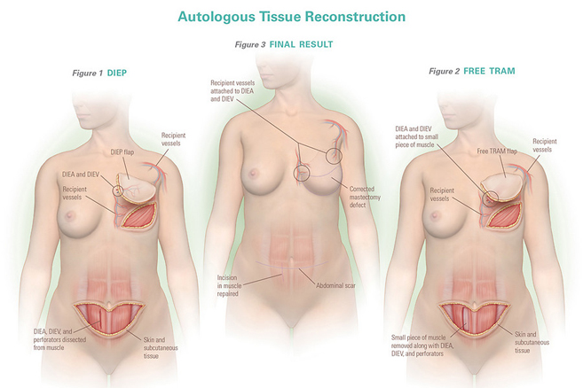 DIEP Flap reconstruction surgery uses tummy tissue to recreate breasts after mastectomy