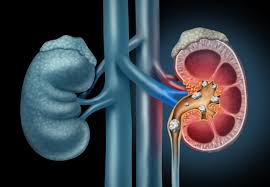 Global Kidney Stones Management Market Revenue To Witness Humongous Elevation By 2026