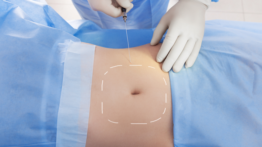 What to Anticipate Before and During A Liposuction Surgery Process?