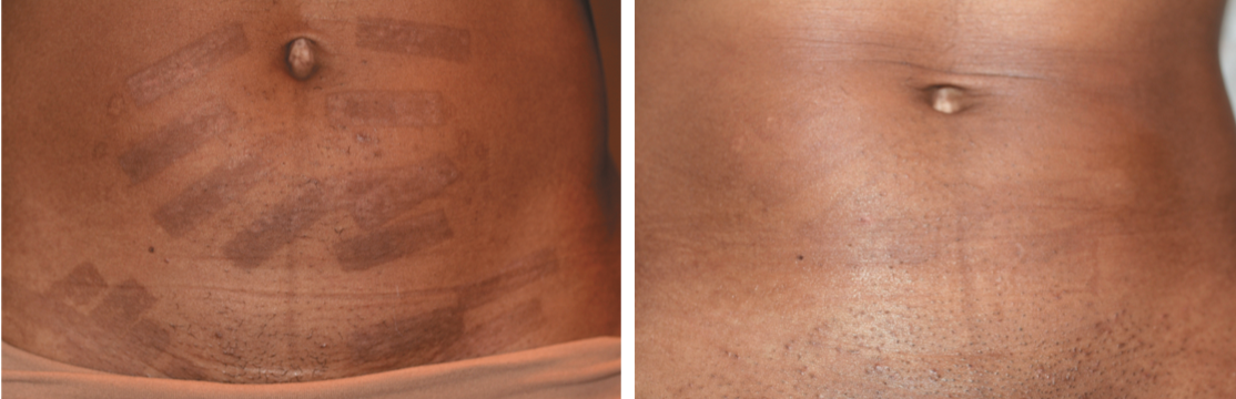 Cosmetic procedure complications in darker skin
