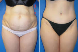 WHAT IS TUMMY TUCK SURGERY OR ABDOMINOPLASTY