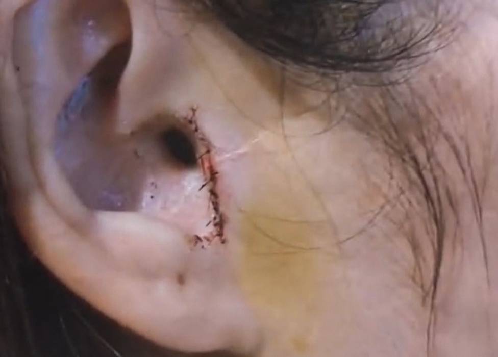 Woman Unknowingly Has Part Of Her Ear Removed During Nose Job Surgery