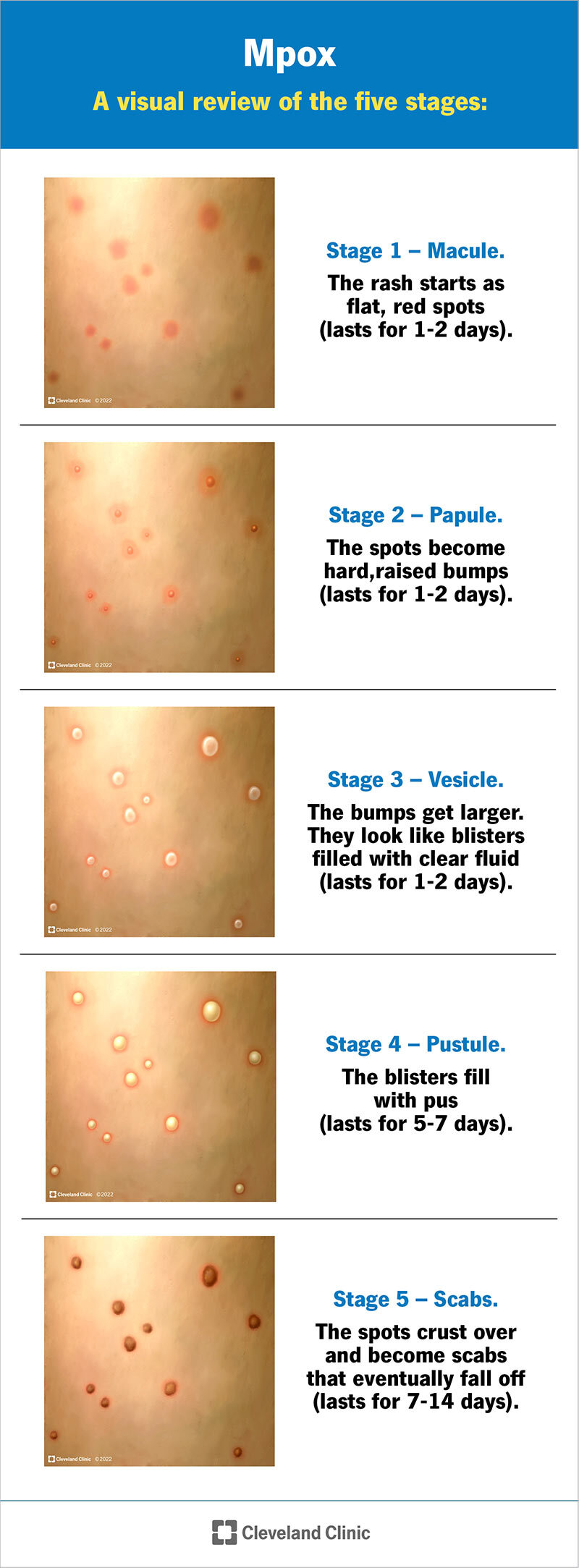 Comprehensive Health Guide on Mpox (Monkeypox) - MyMedicPlus